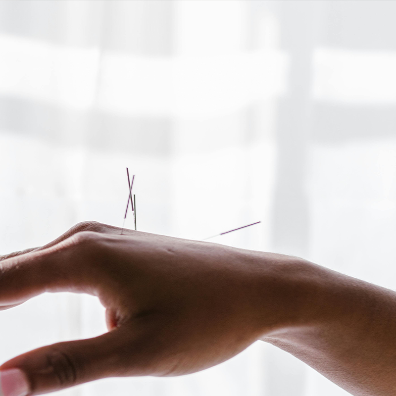 Needles On Woman Hand Acupuncture Needles On Woman Hand